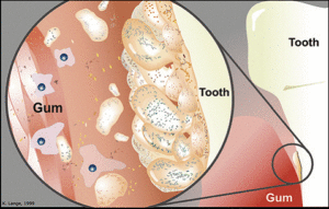 Periodontal Gum Disease