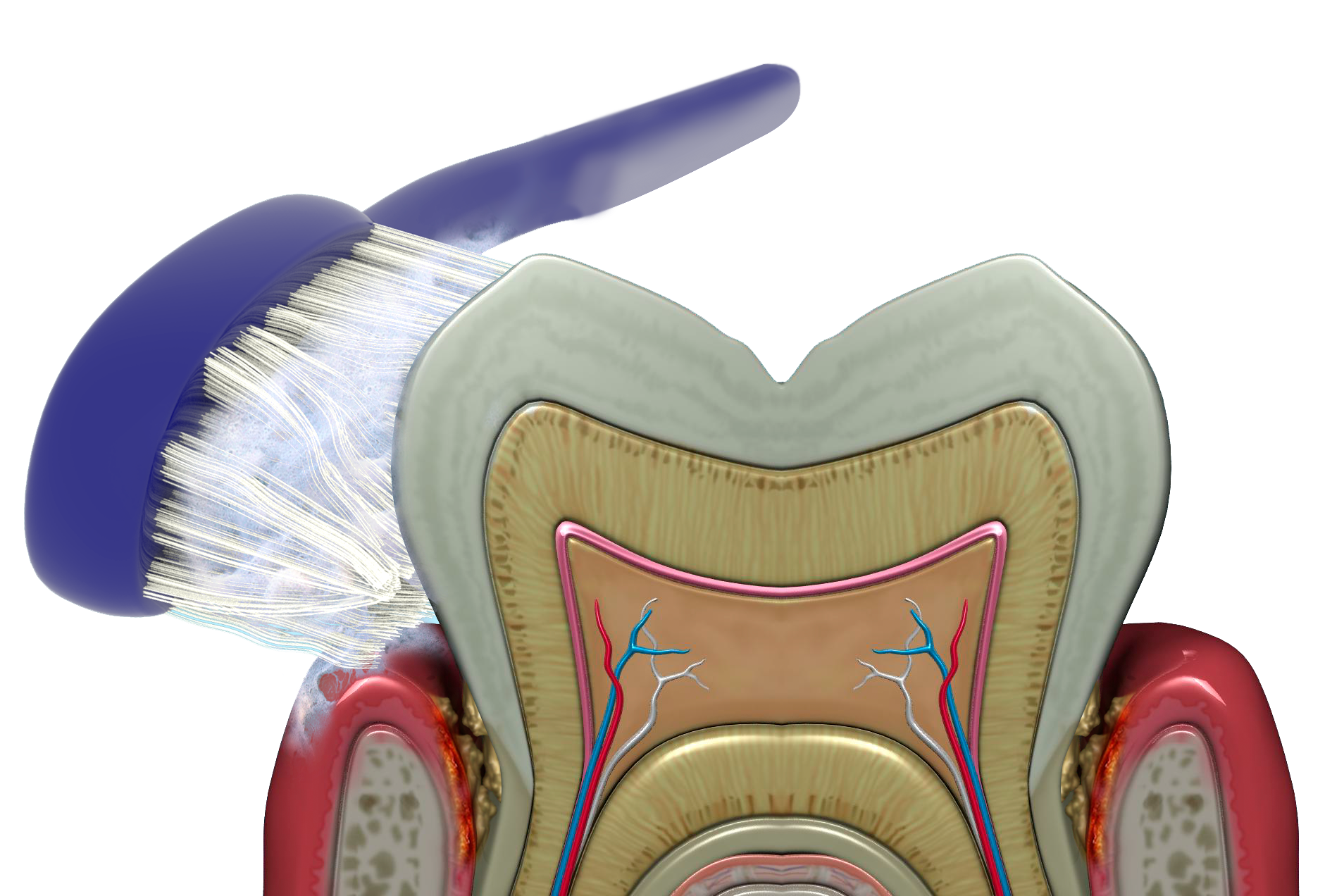 Brushing Brushing, rinsing and flossing cannot reach the bacteria.