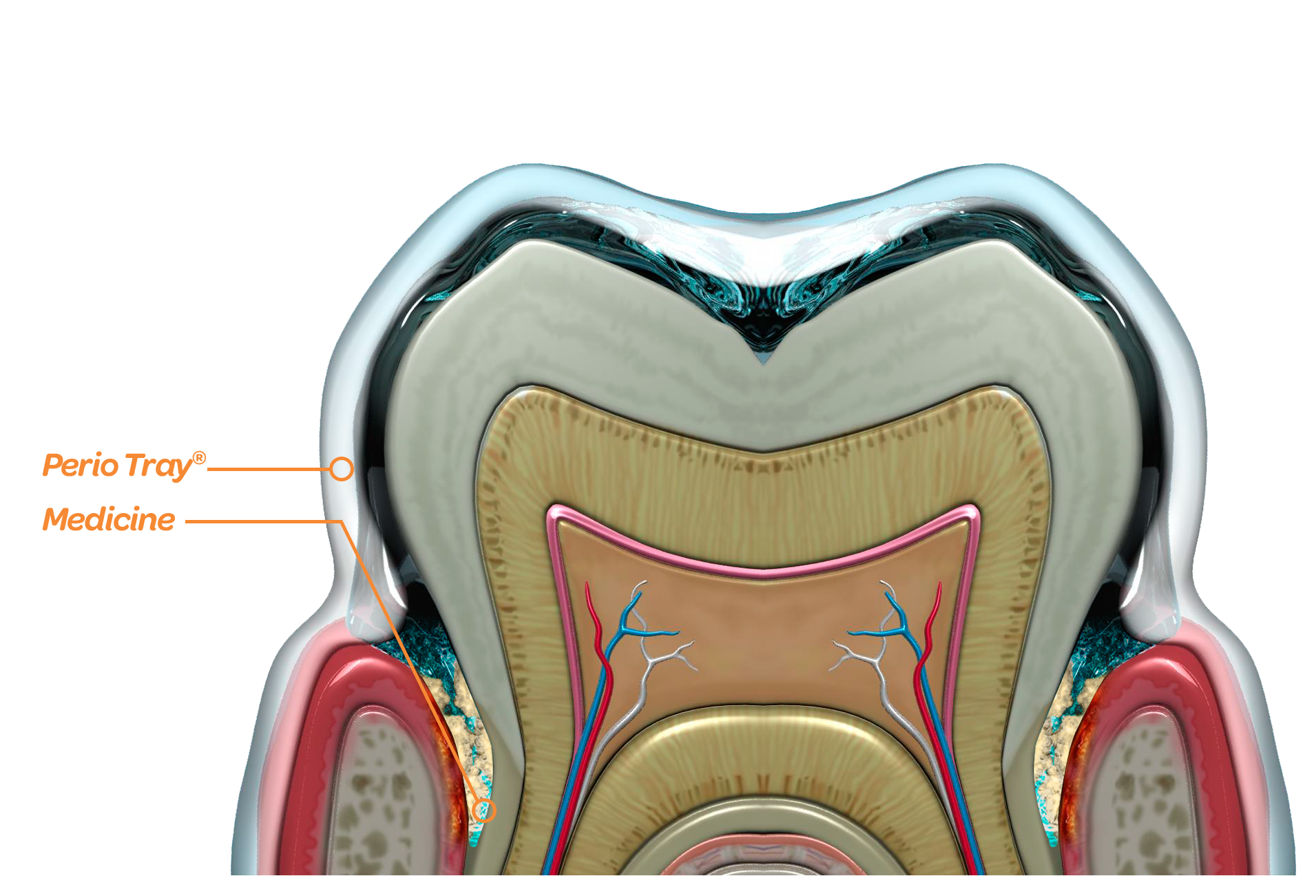 The Perio Tray® delivers medicine into the periodontal pockets and holds it there.