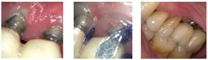 Case couresy of Dr. Lou Graham of University Dental Professionals