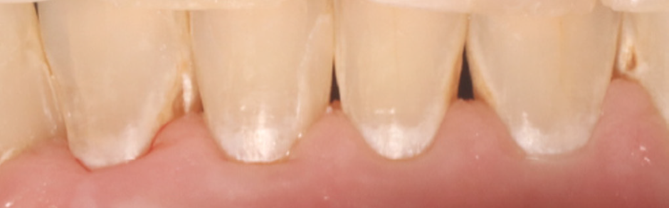 day 0 picture of teeth before remingel with white spots from missing enamel