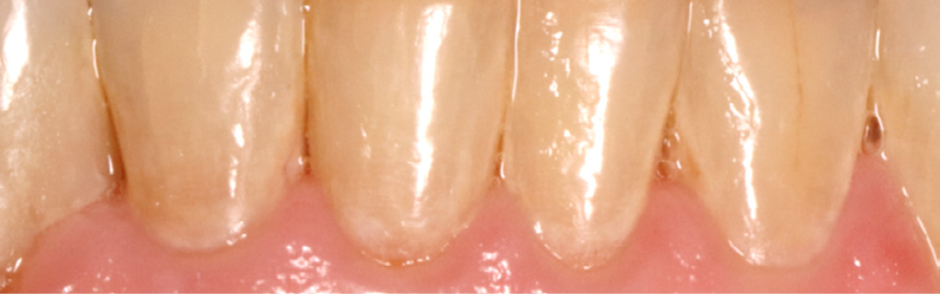 day 90 picture after remingel with significant improvement in white spots